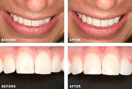 Porcelain Veneers Northborough MA