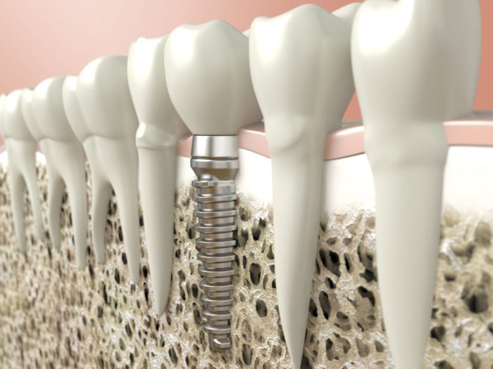 Dental implants by Northborough cosmetic dentist