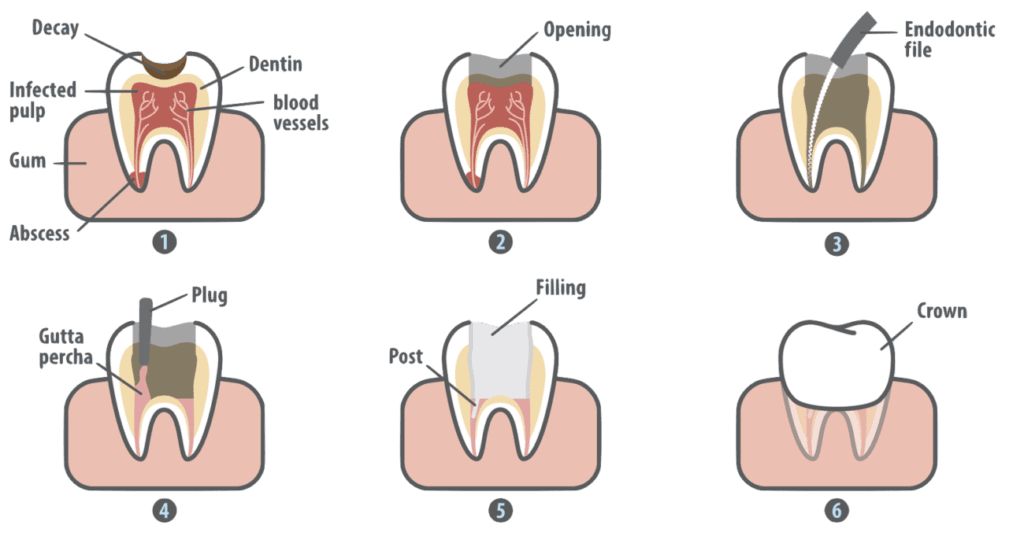 Root Canal in Northborough, Massachusetts near you