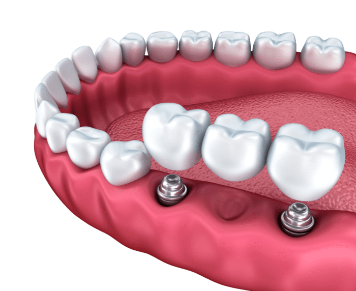 dental bridge secured with dental implants in Northborough, MA