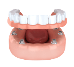 dental implant secured denture northborough ma