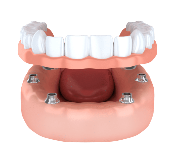 dental implant-secured denture Northborough, MA