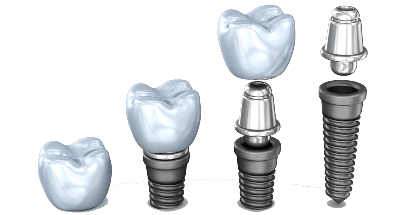 implant pieces dental implant dentist northborough ma