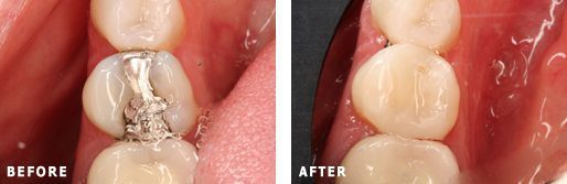 CEREC procedure in Northborough MA at Apex Dental