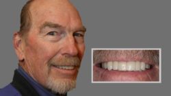 Special offer on Zoom teeth whitening!