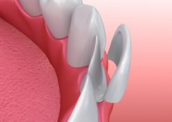Transform Your Smile With Porcelain Veneers