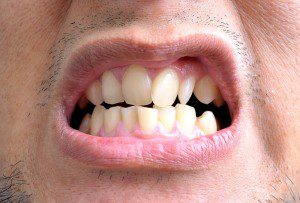 Why Crooked Teeth Are A Real Problem