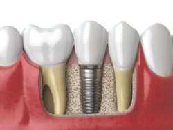 Missing Teeth: Implants, Bridges, and Dentures