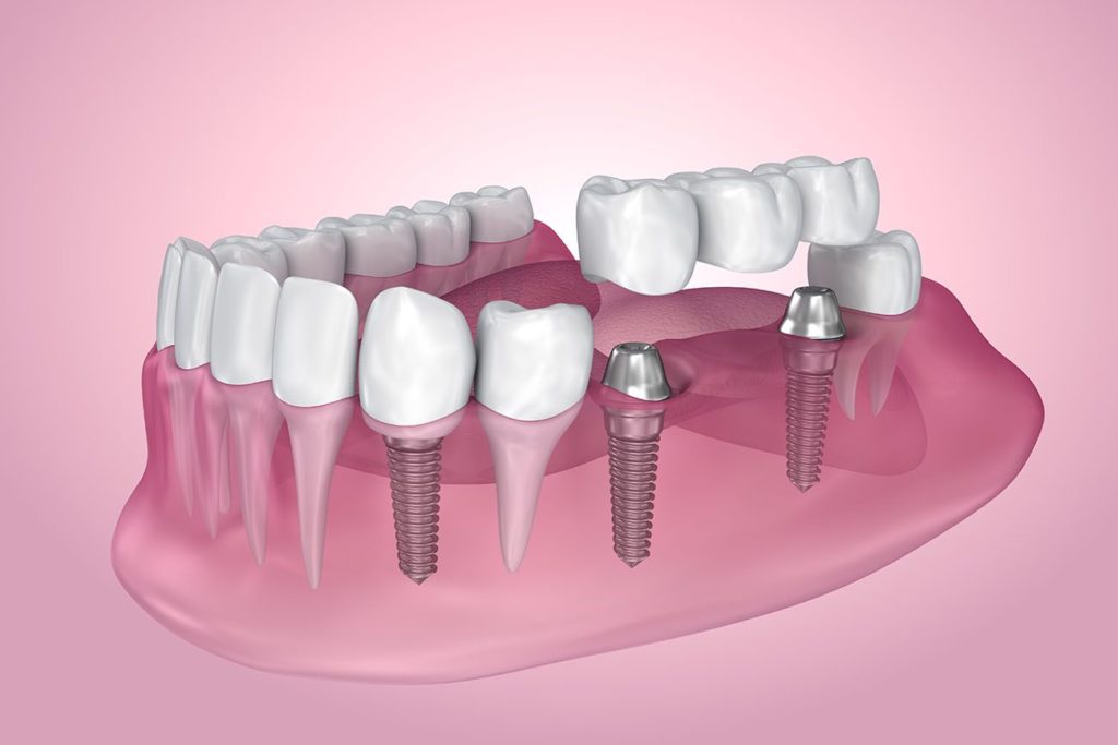multiple dental implants Northborough Massachusetts