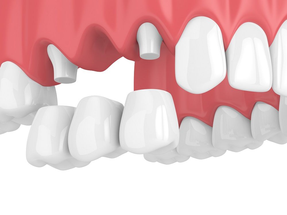 traditional dental bridges