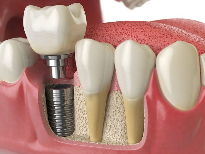 Replacing Teeth After Gum Disease