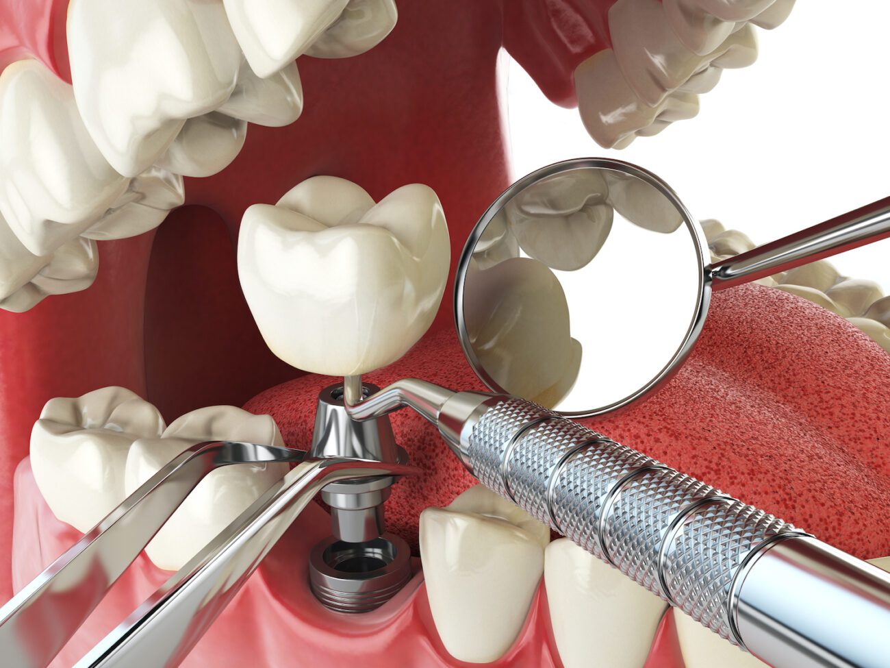 Understanding the causes of missing teeth and the benefits of dental implants can help you make an informed decision about your oral health.  