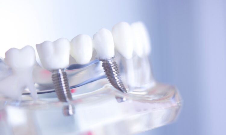 Understanding the cost of dental implants and your financing options can help you make an informed decision about your oral health and smile.