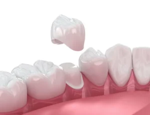 Times You Might Need a Dental Crown in Northborough, MA